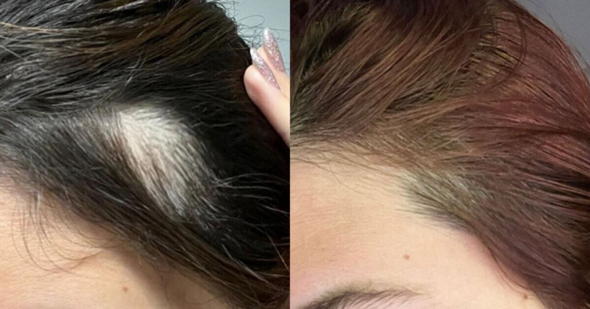 Thinning hair stopped shedding ‘almost instantly’ with growth serum