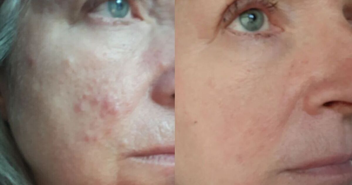 Scar serum that ‘helps wrinkles’ now £24 in early Black Friday sale