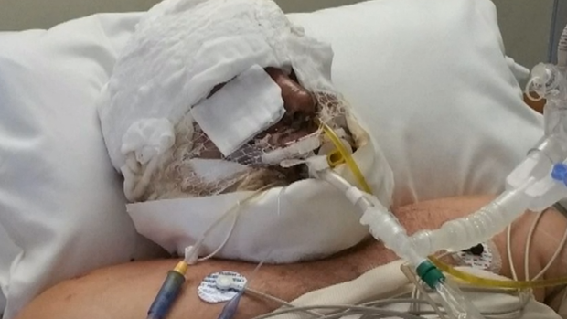 U.S. citizen billed $1.7 million by government for life-saving burn treatment: “Completely hopeless”