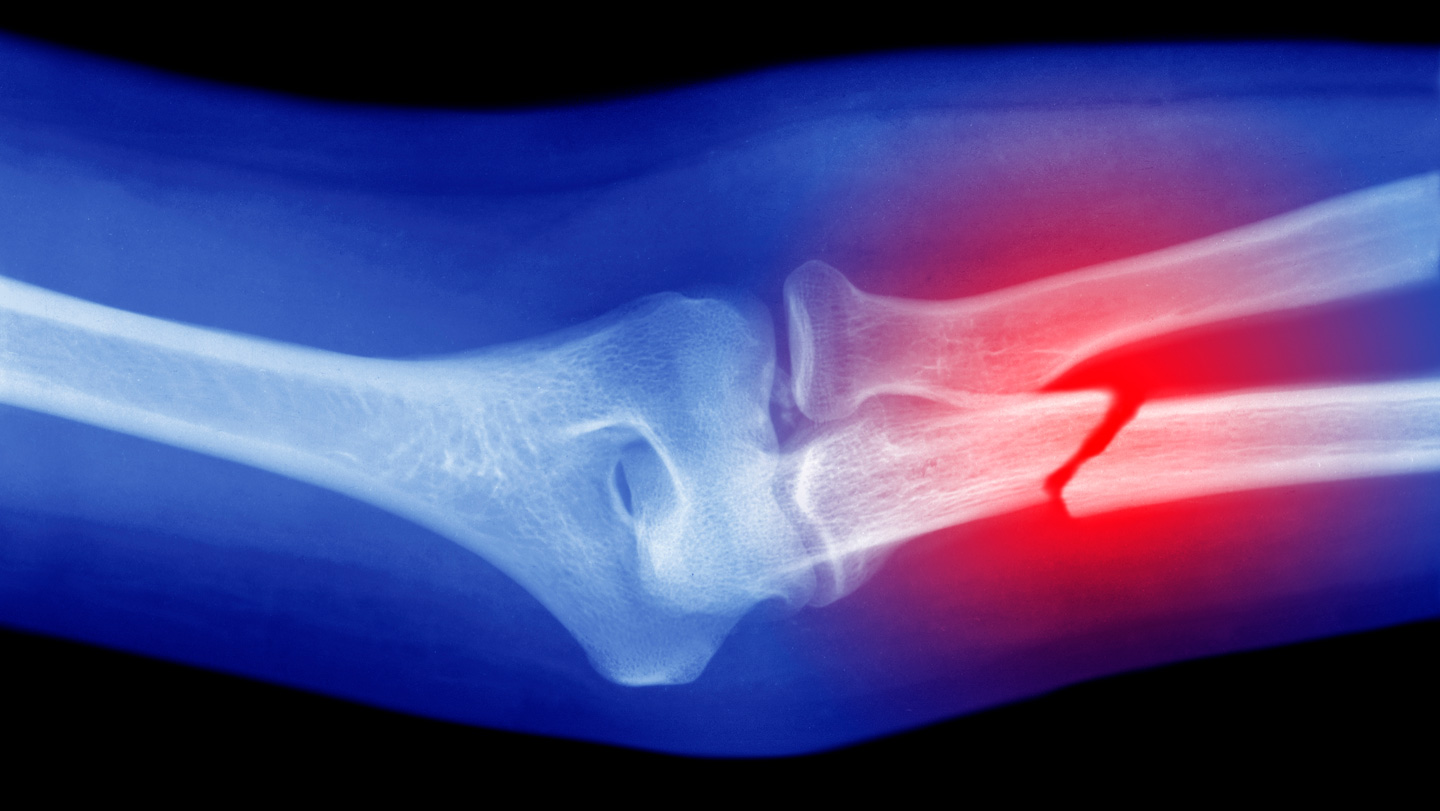 A handheld ‘bone printer’ shows promise in animal tests